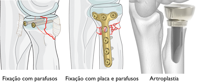 Fratura Da Cabeca Do Radio Dr Eduardo Malavolta