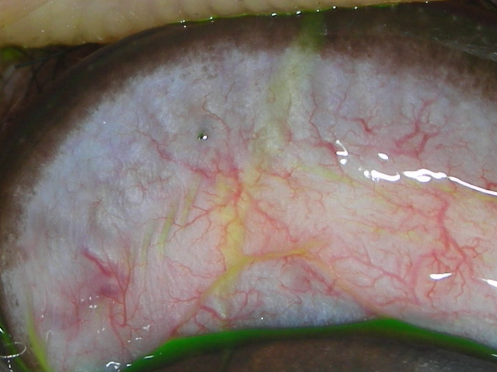 Ectopic Cilia