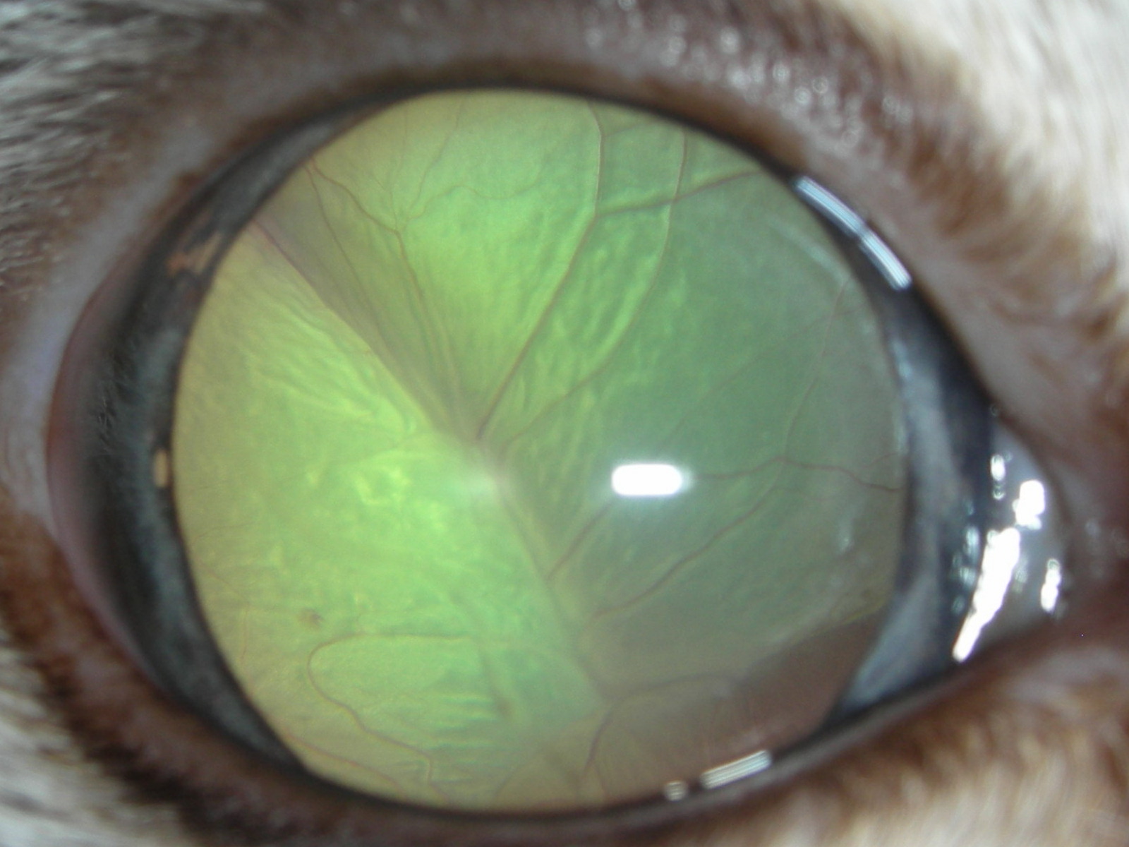 Hypertensive Retinopathy