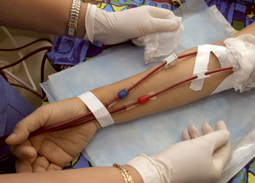 dialysis and infiltration_C.F.-05.29.13.jpg