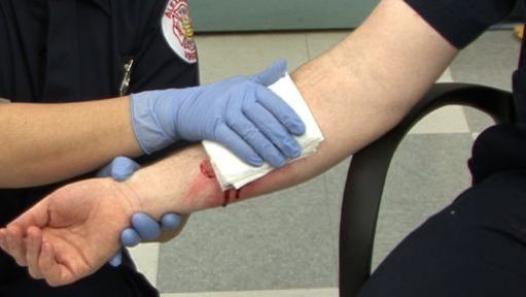 AV Fistula Ruptures And Hemorrhages -Signs And Symptoms Often Missed Can Be Deadly For CKD — KidneyBuzz AV Fistula Ruptures And Hemorrhages -Signs And Symptoms Often Missed Can Be Deadly For CKD — KidneyBuzz
