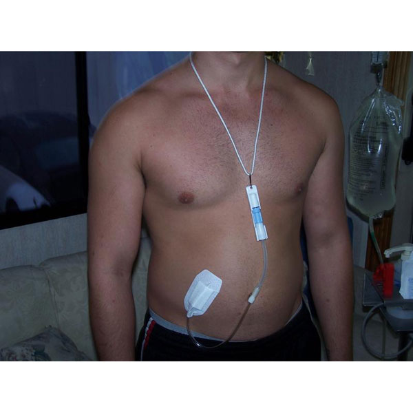 the-reasons-for-the-recent-sharp-decline-in-use-of-peritoneal-dialysis