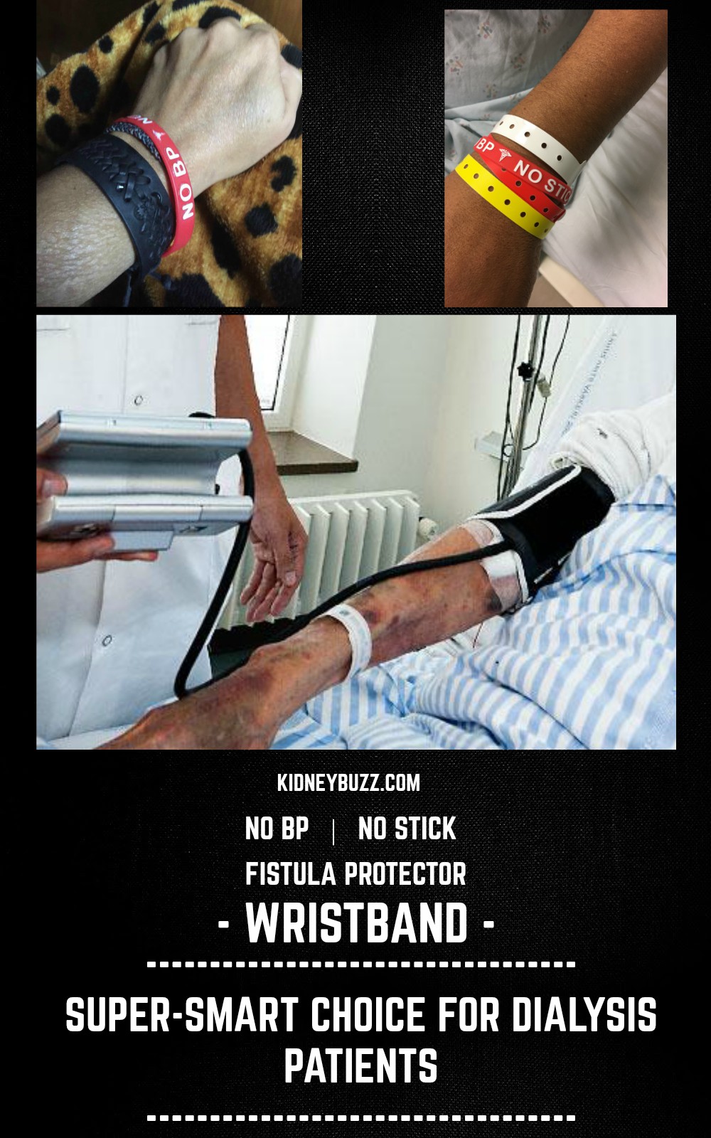 AV Fistula Ruptures And Hemorrhages -Signs And Symptoms Often Missed Can Be Deadly For CKD — KidneyBuzz AV Fistula Ruptures And Hemorrhages -Signs And Symptoms Often Missed Can Be Deadly For CKD — KidneyBuzz