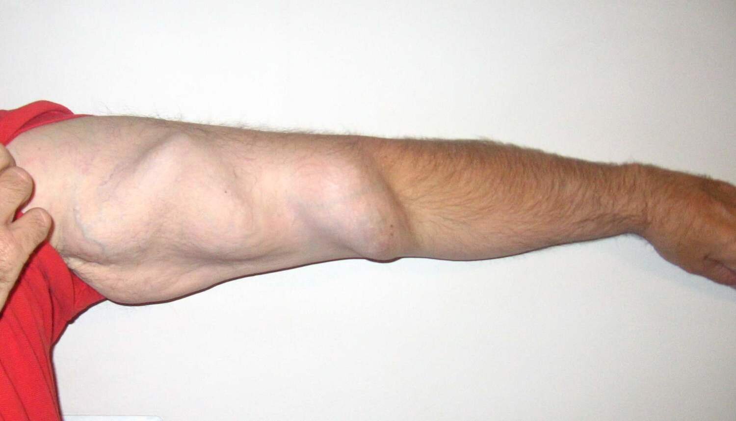Normal Dialysis Fistula normal-dialysis-fistula