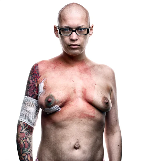 Aaron Goldman - "Breast Cancer"