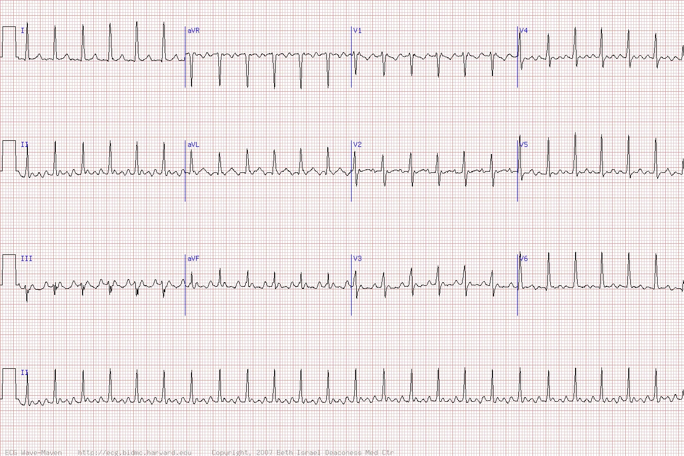 суправентрикулярная тахикардия комплекс qrs. Av узловая тахикардия на экг. критерии наджелудочковой пароксизмальной тахикардии на экг. атриовентрикулярная пароксизмальная тахикардия на экг. Av узловая реципрокная тахикардии экг.
