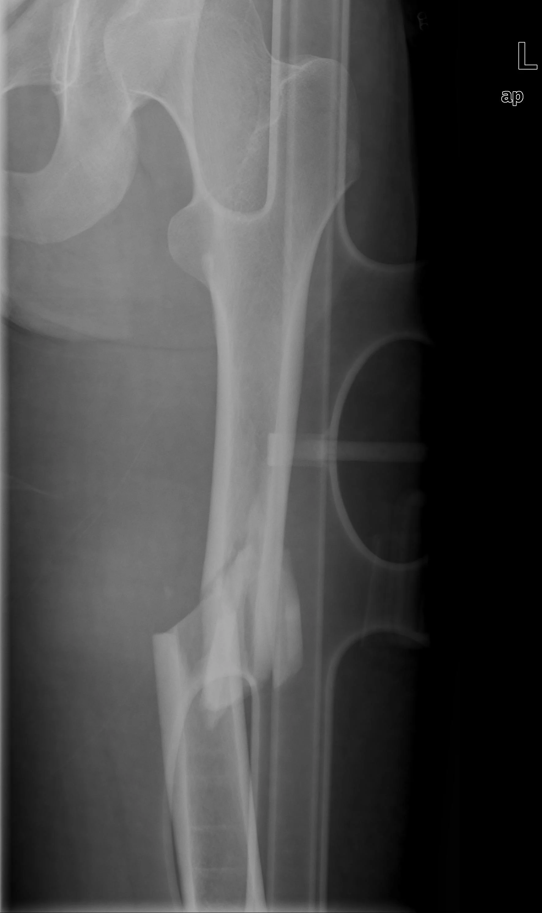 Femoral Fracture X-ray 1