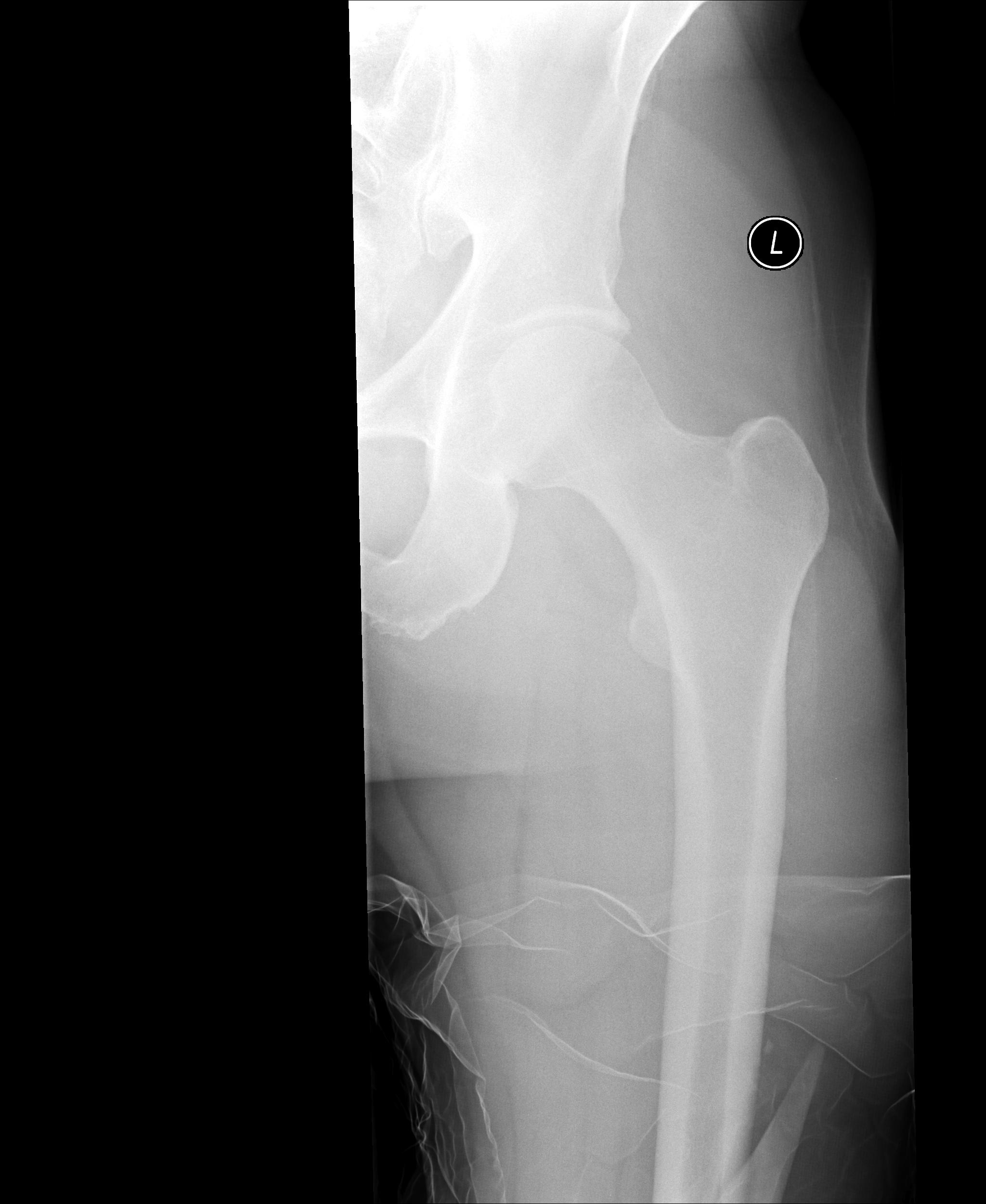 Femoral Fracture X-ray 4