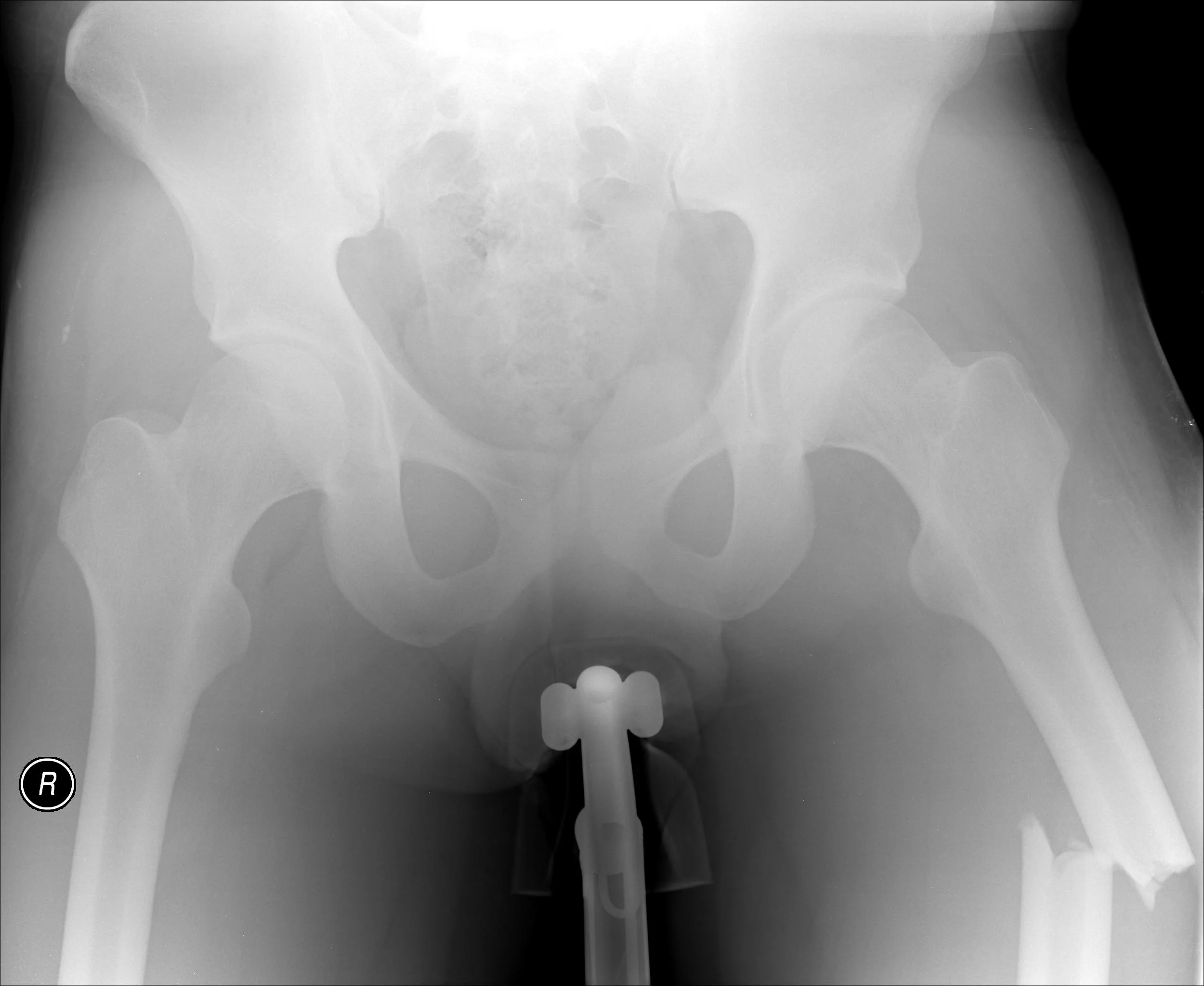 Femoral Fracture X-ray 5