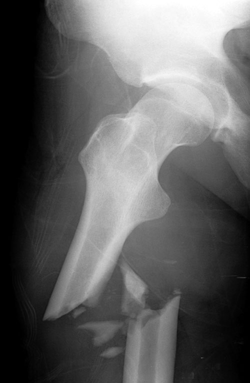 Femur Fracture X-ray 2