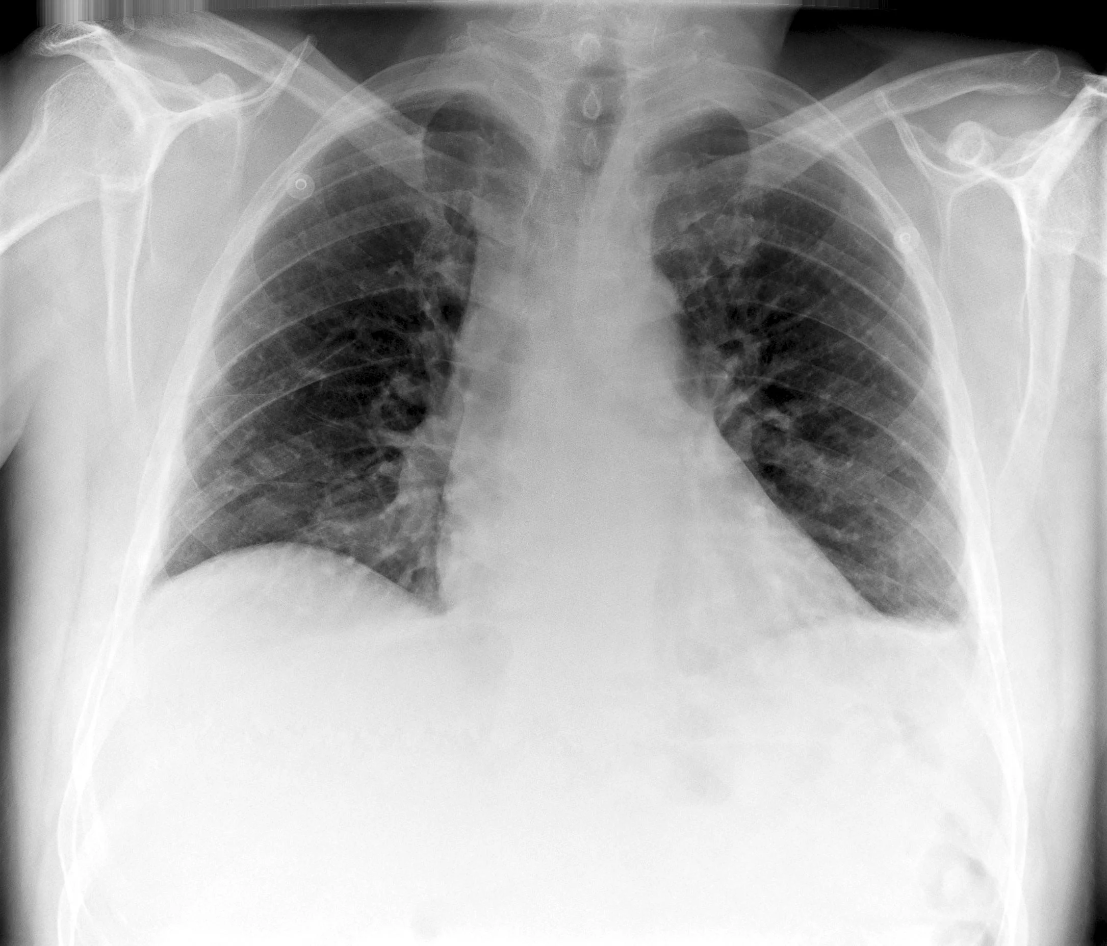 Fluid Levels Leftside X-ray (mild)