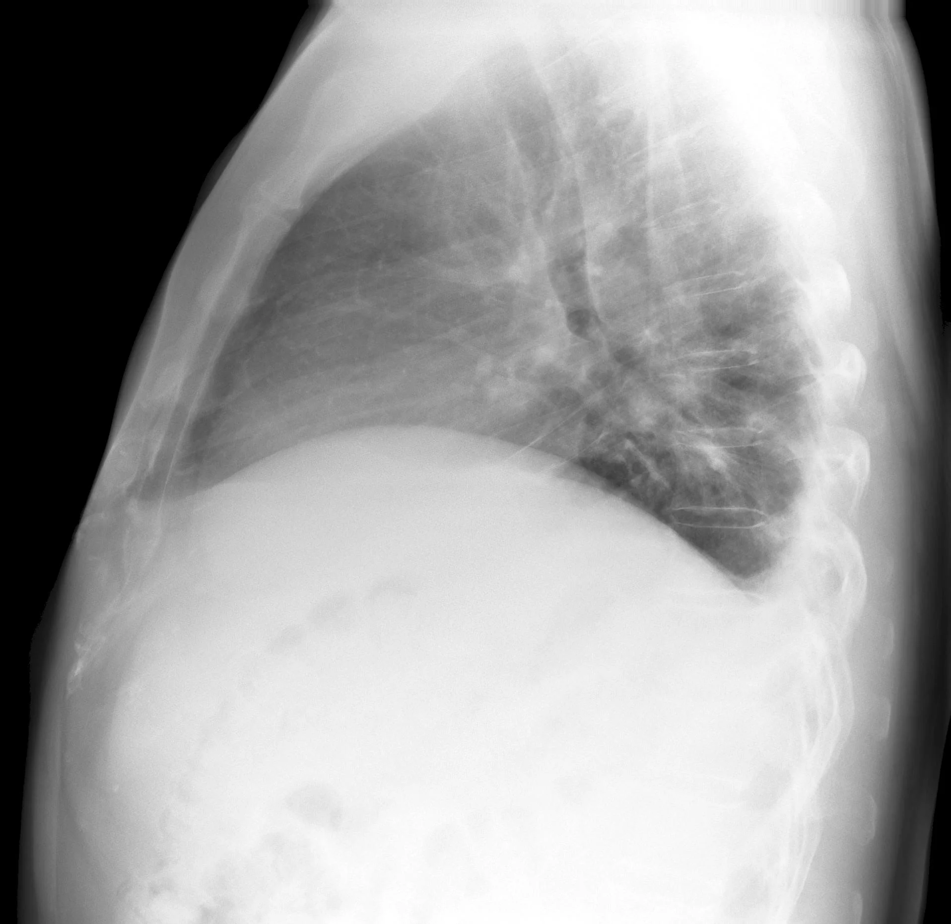 Fluid Levels Leftside X-ray (mild, lateral)