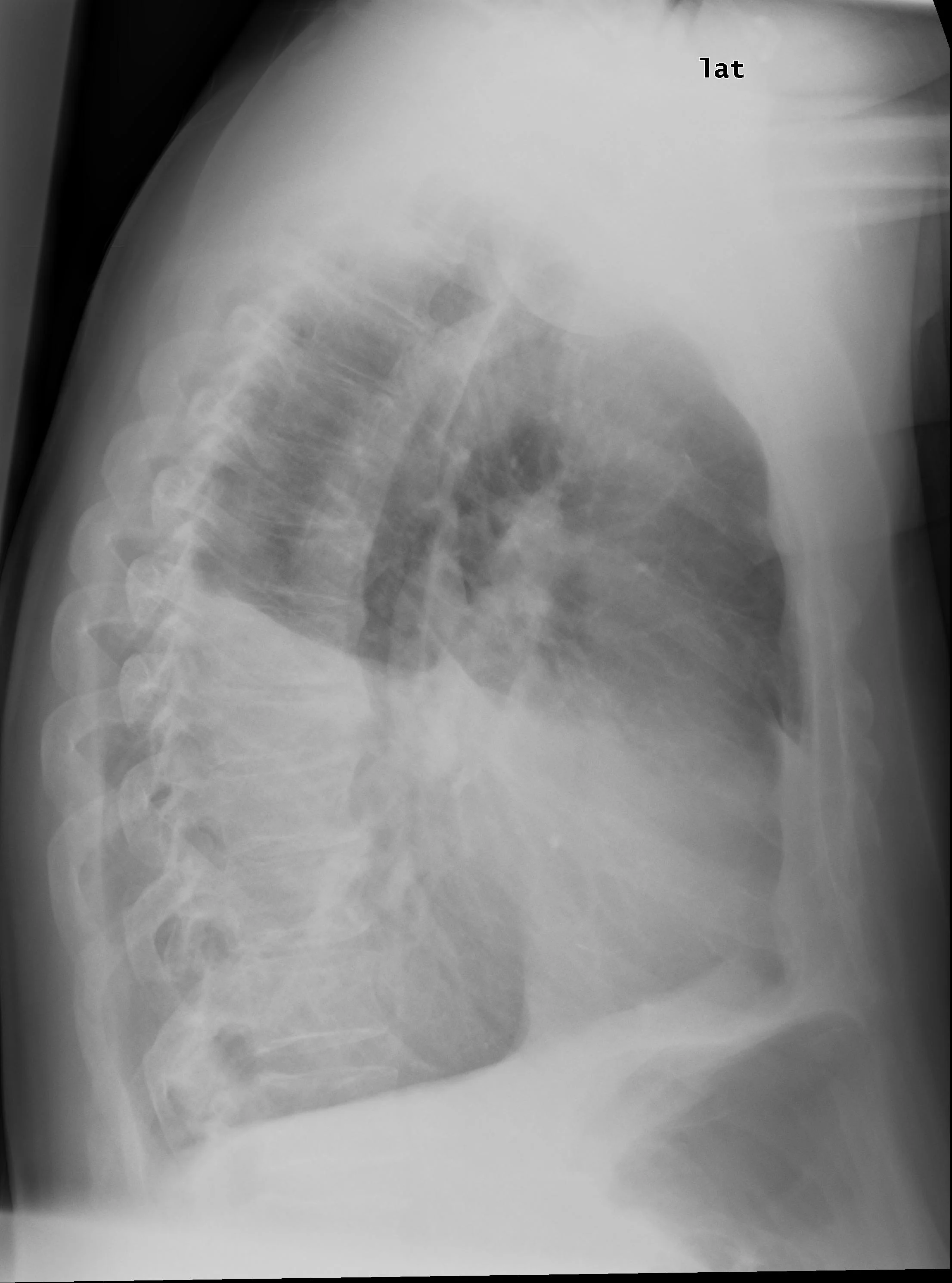 Fluid Levels Leftside X-ray (severe, lateral)