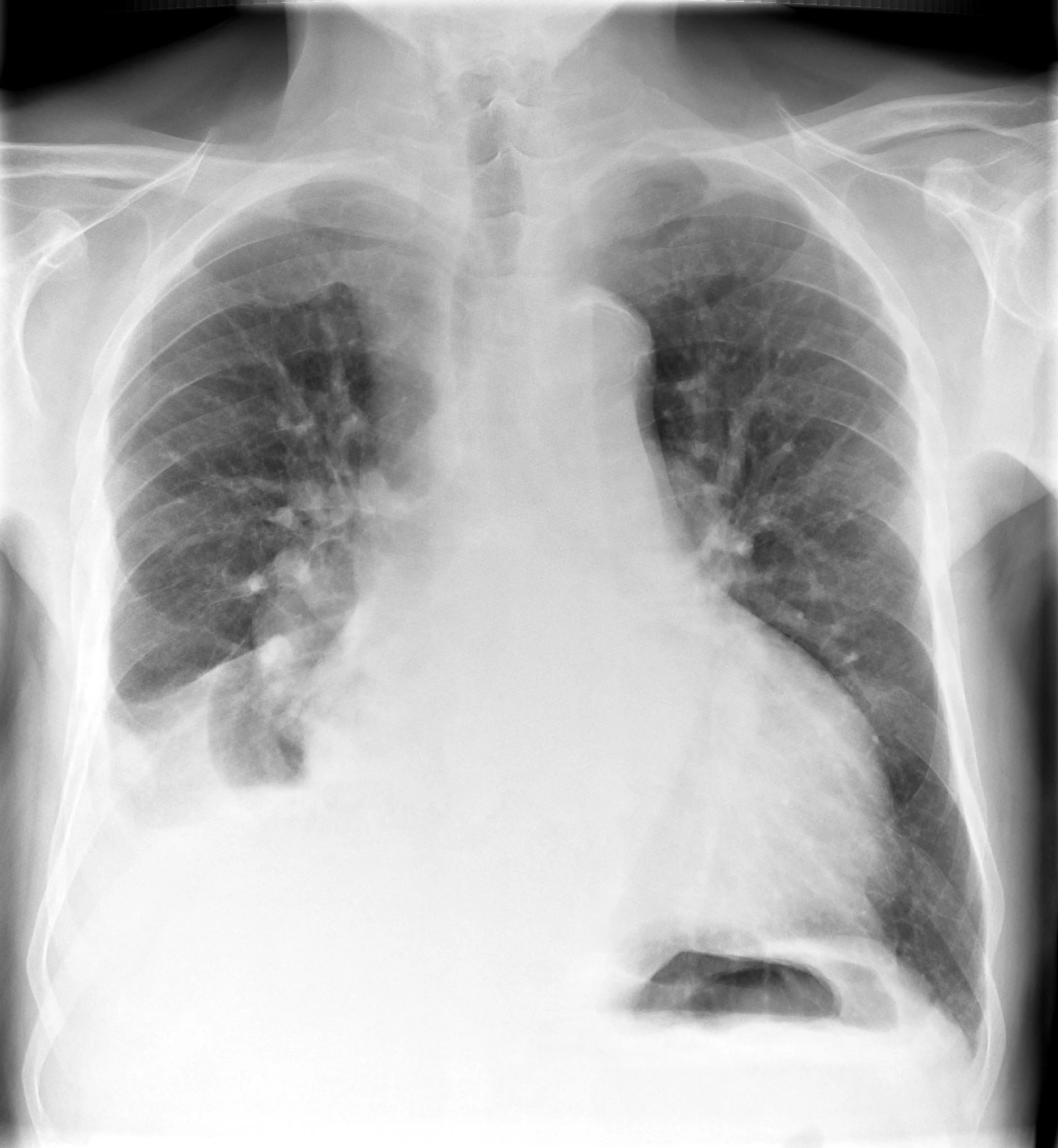 Fluid Levels Rightside X-ray (moderate)