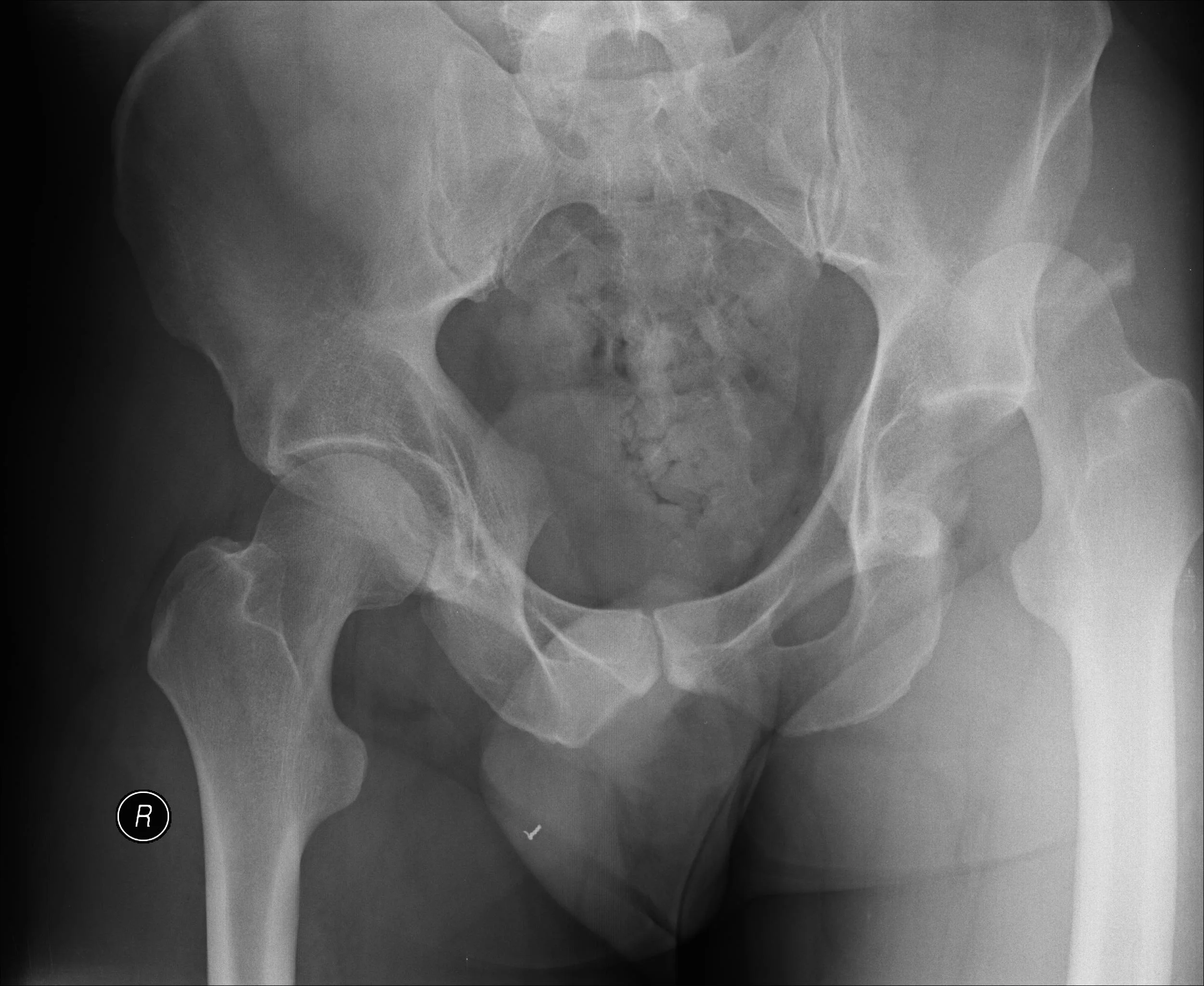 Hip Subluxation X-ray