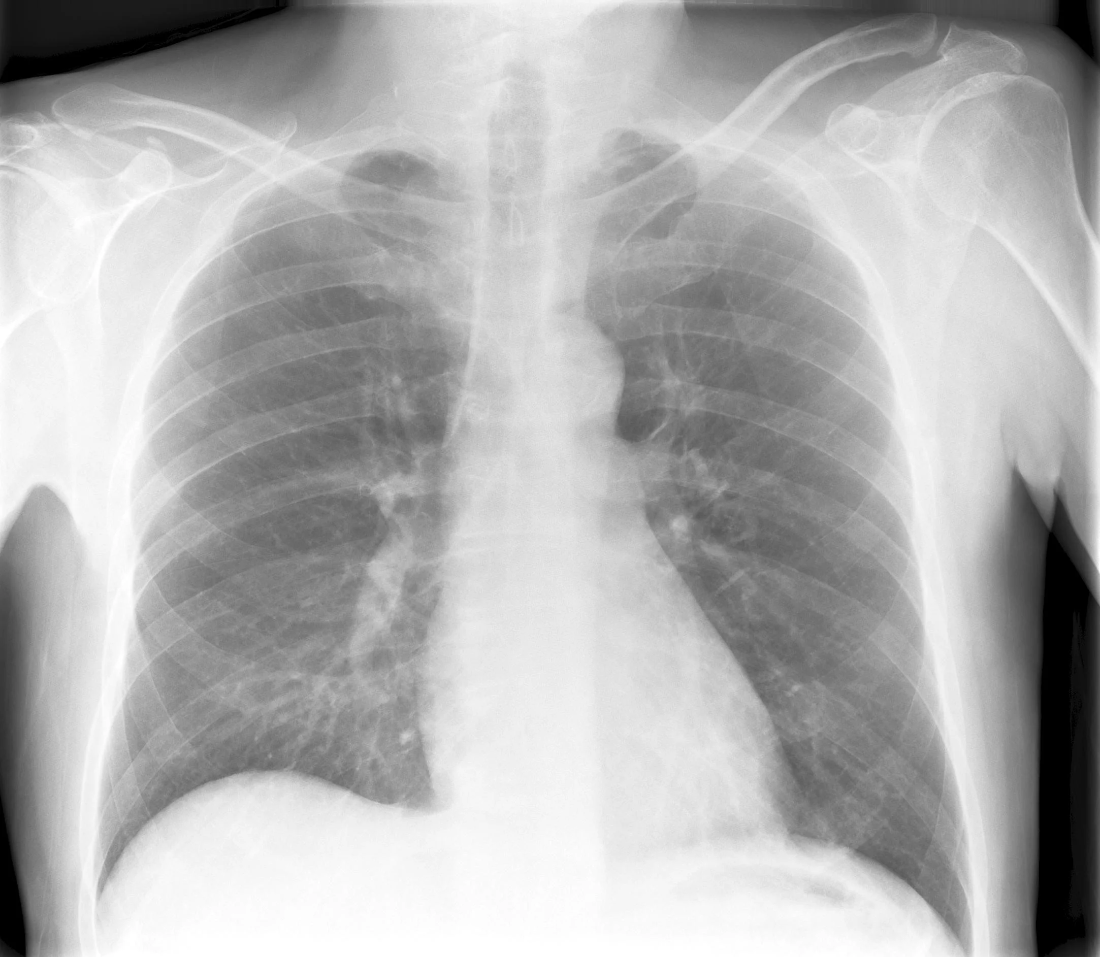 Normal Chest X-ray 1