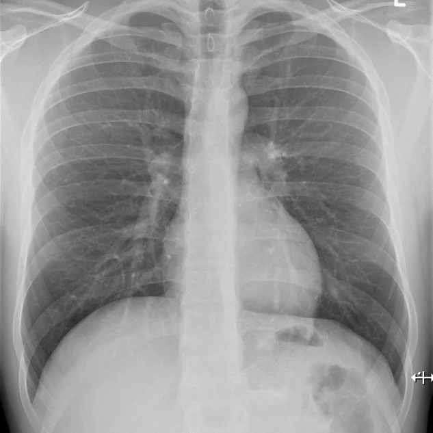 Normal Chest X-ray 3