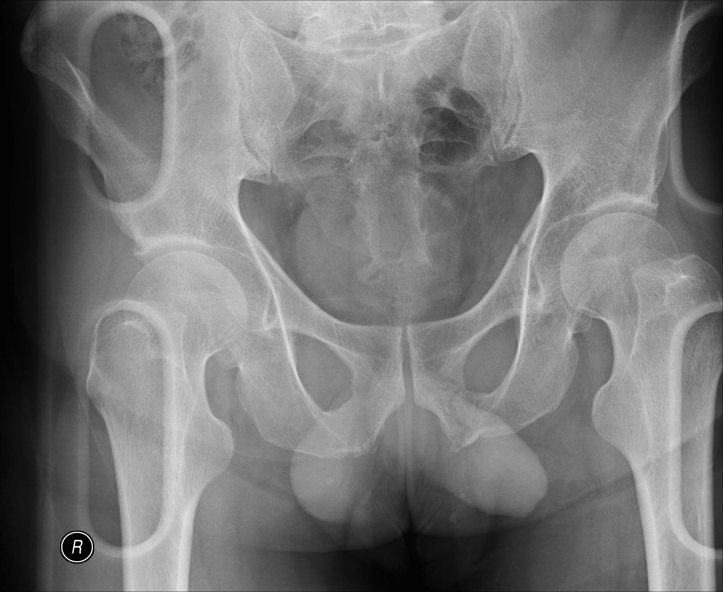 Pelvis Fracture X-ray 2