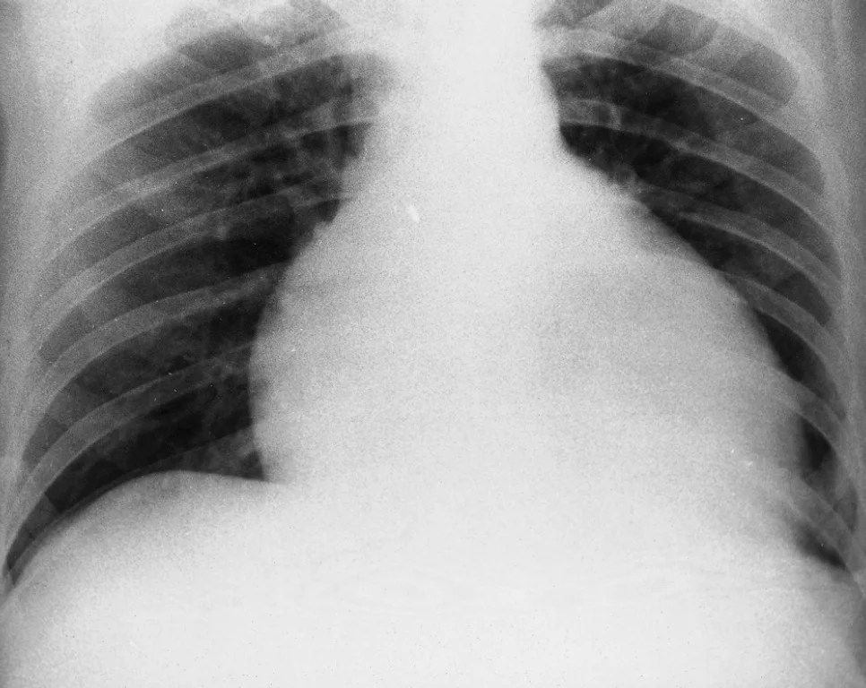 Pericardial Tamponade X-ray