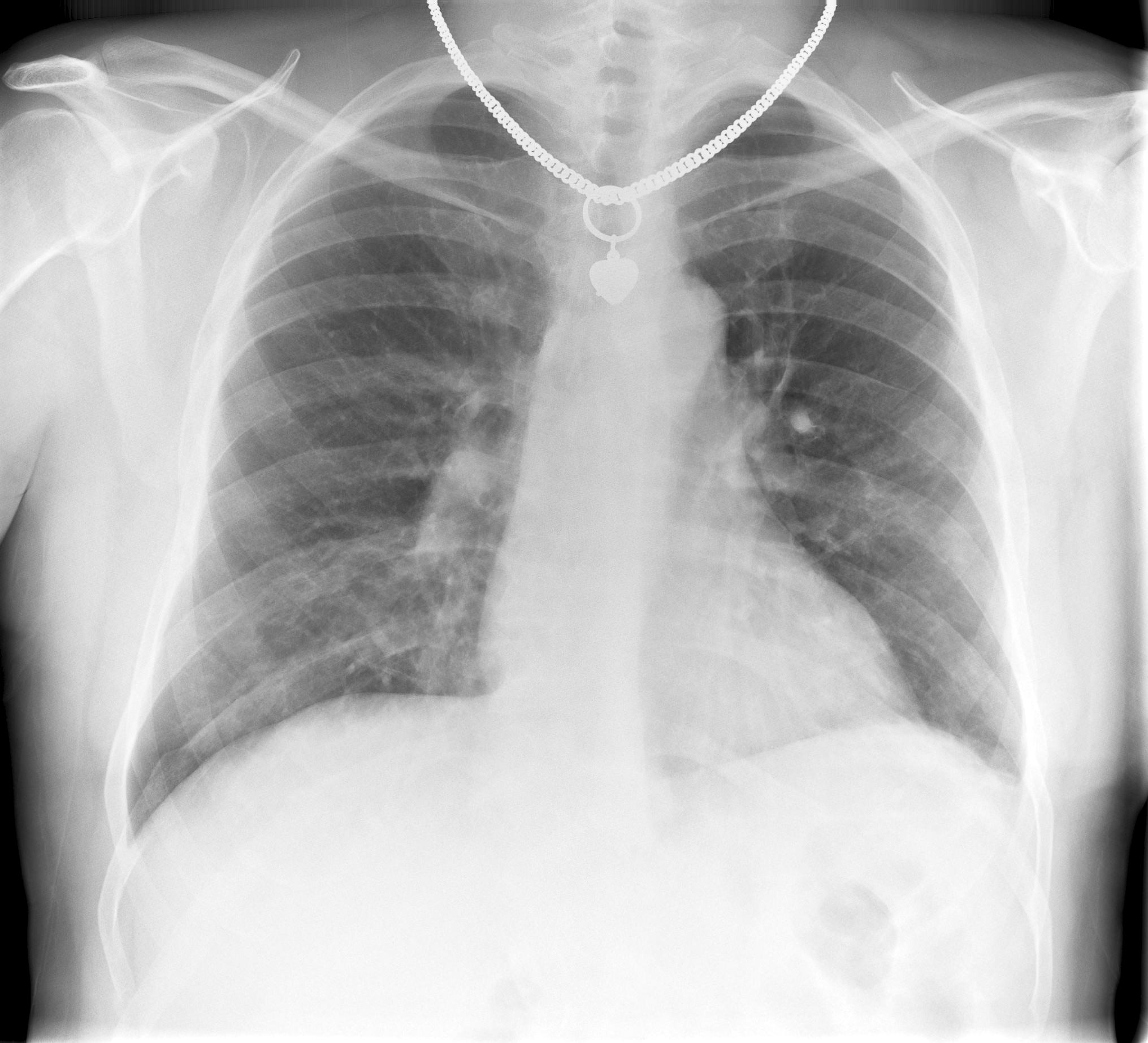 Pneumonia Leftside Segmental X-ray