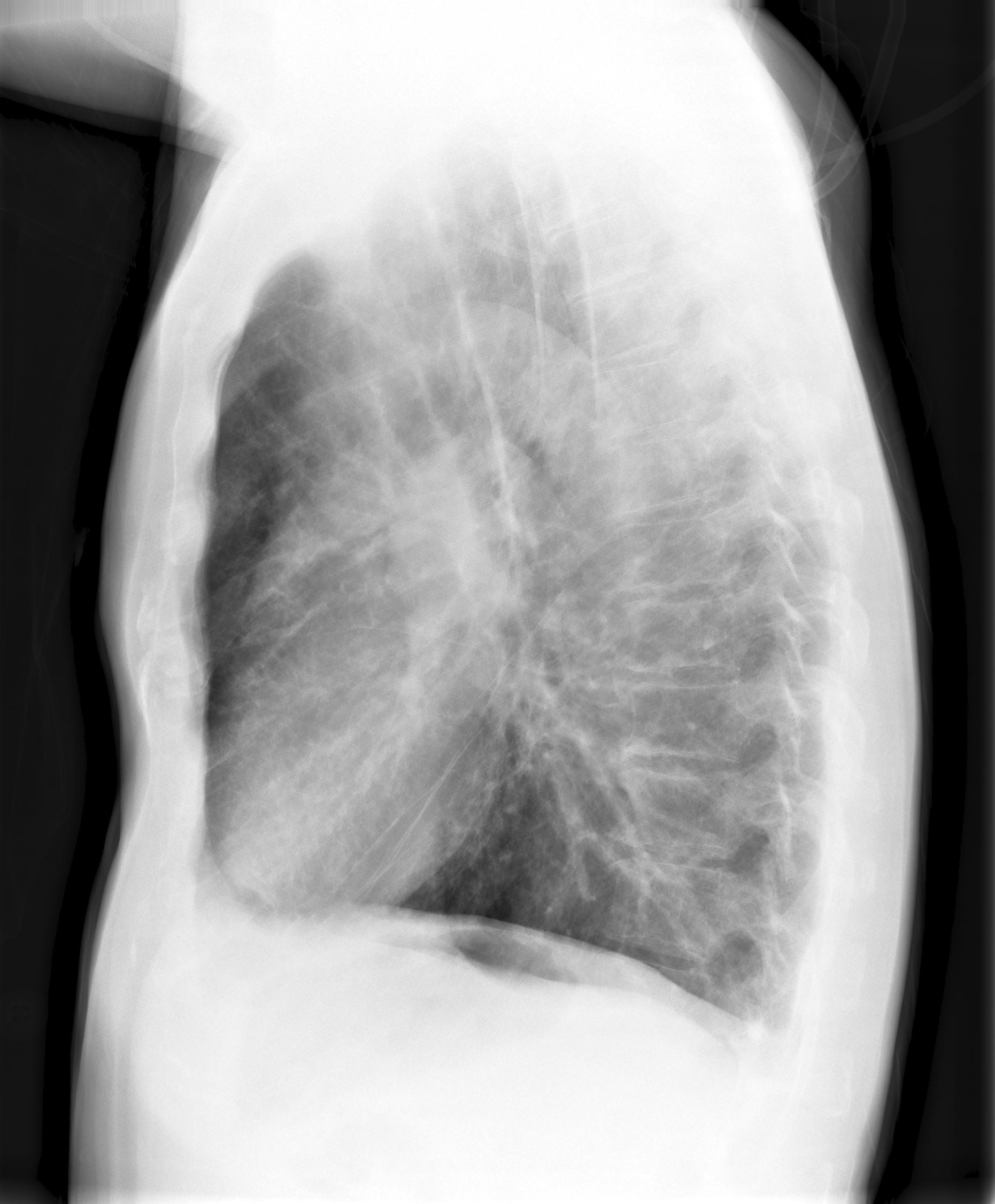 Pneumonia Rightside Diffuse X-ray (lateral)