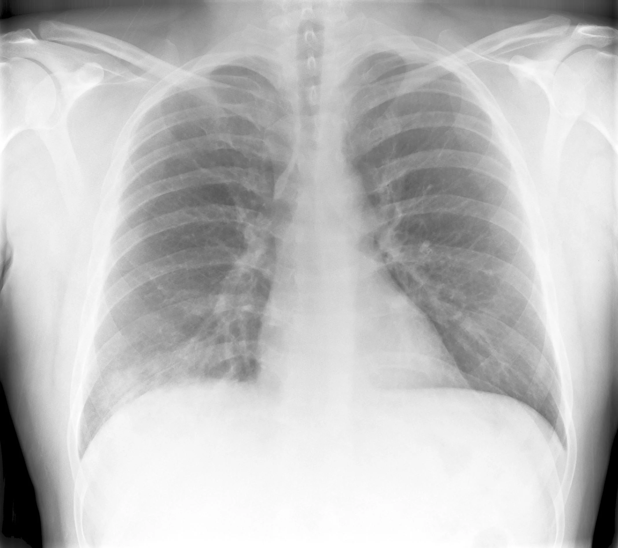 Pneumonia Rightside Segmental X-ray 2