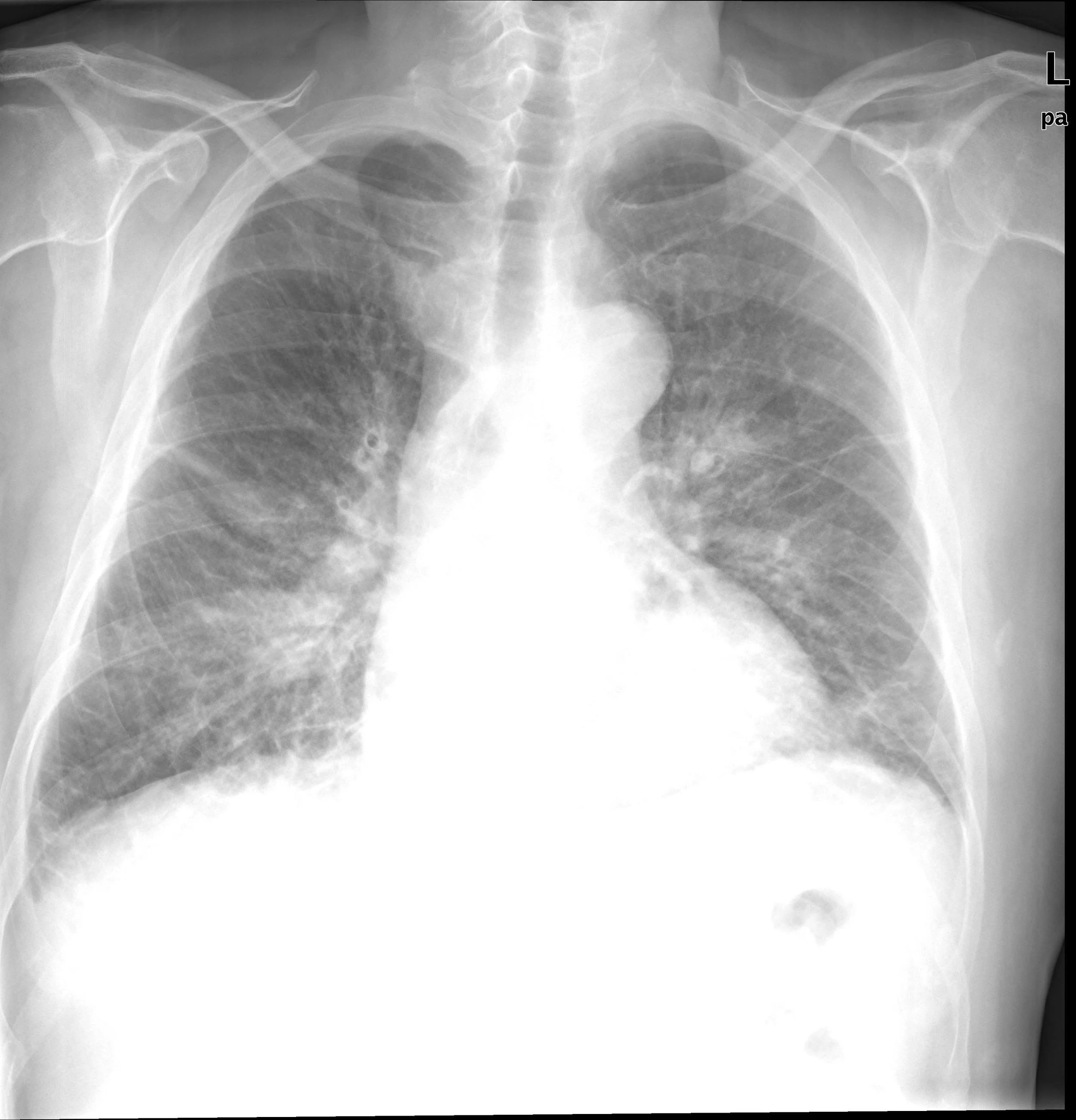 Pulmonary Edema X-ray (moderate) 2