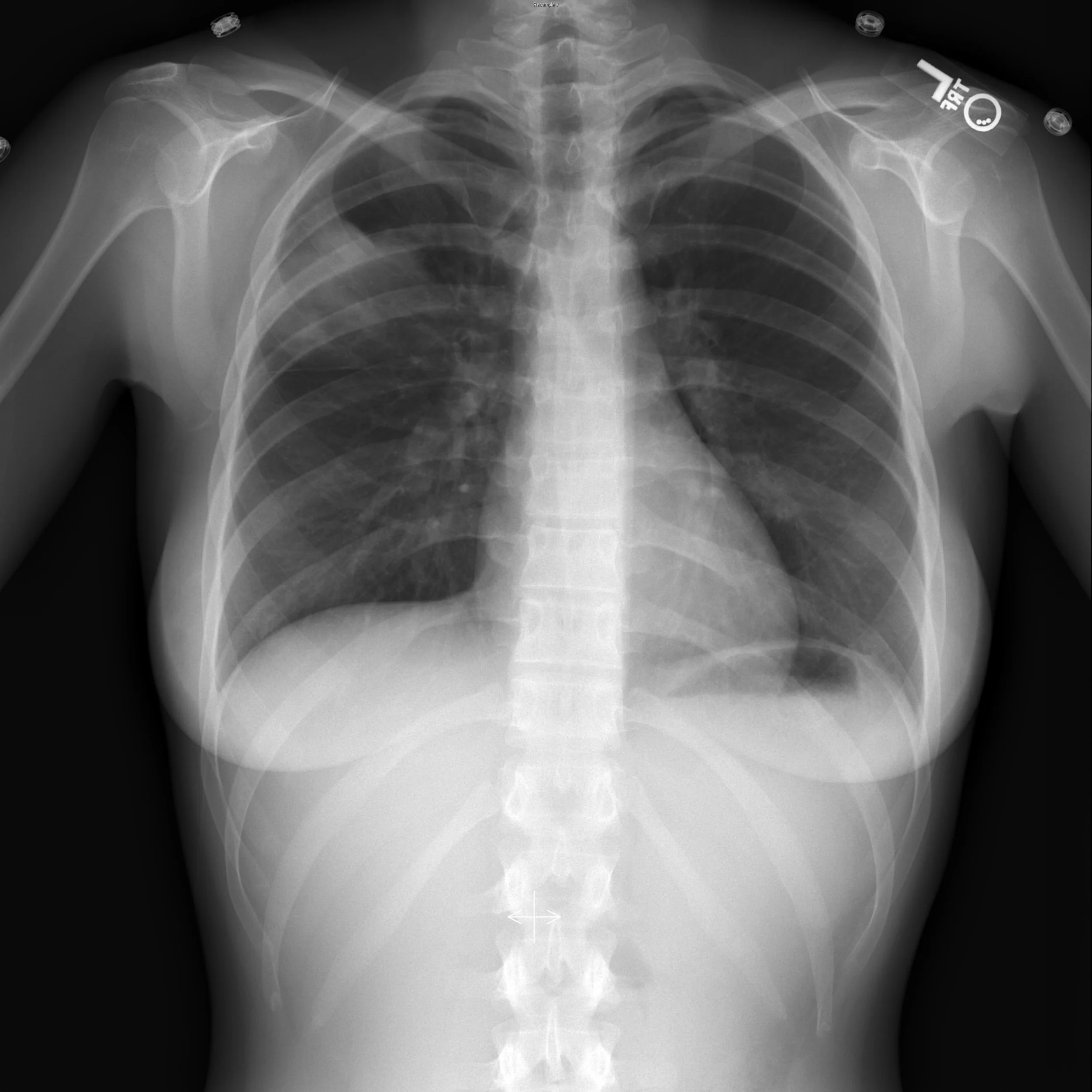 Right Upper Lobe X-ray (female)
