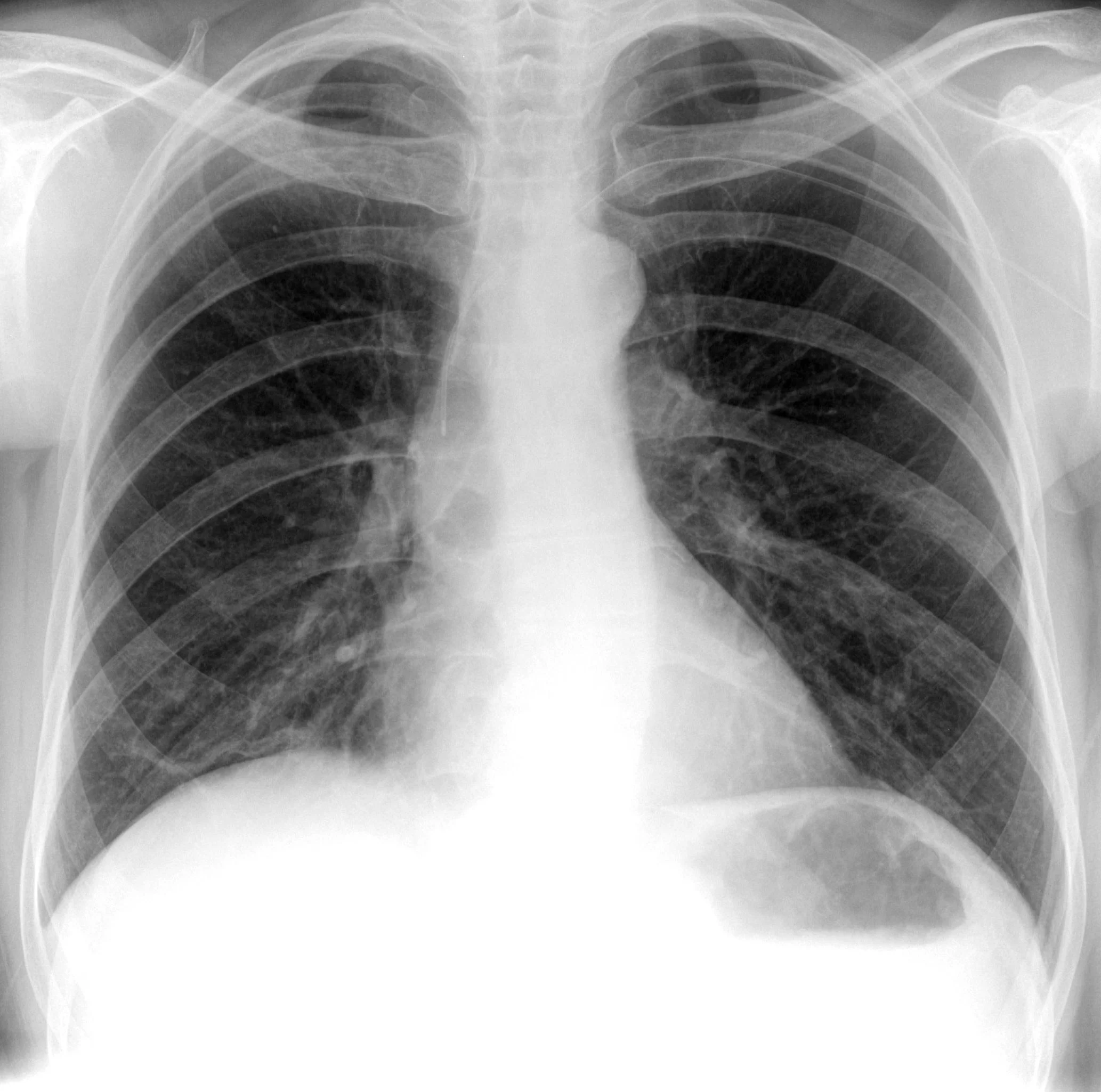 PICC Line X-ray 2