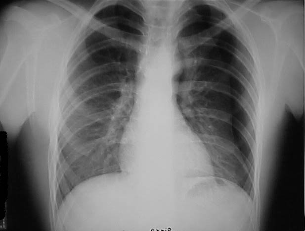 Pneumothorax X-ray (moderate)