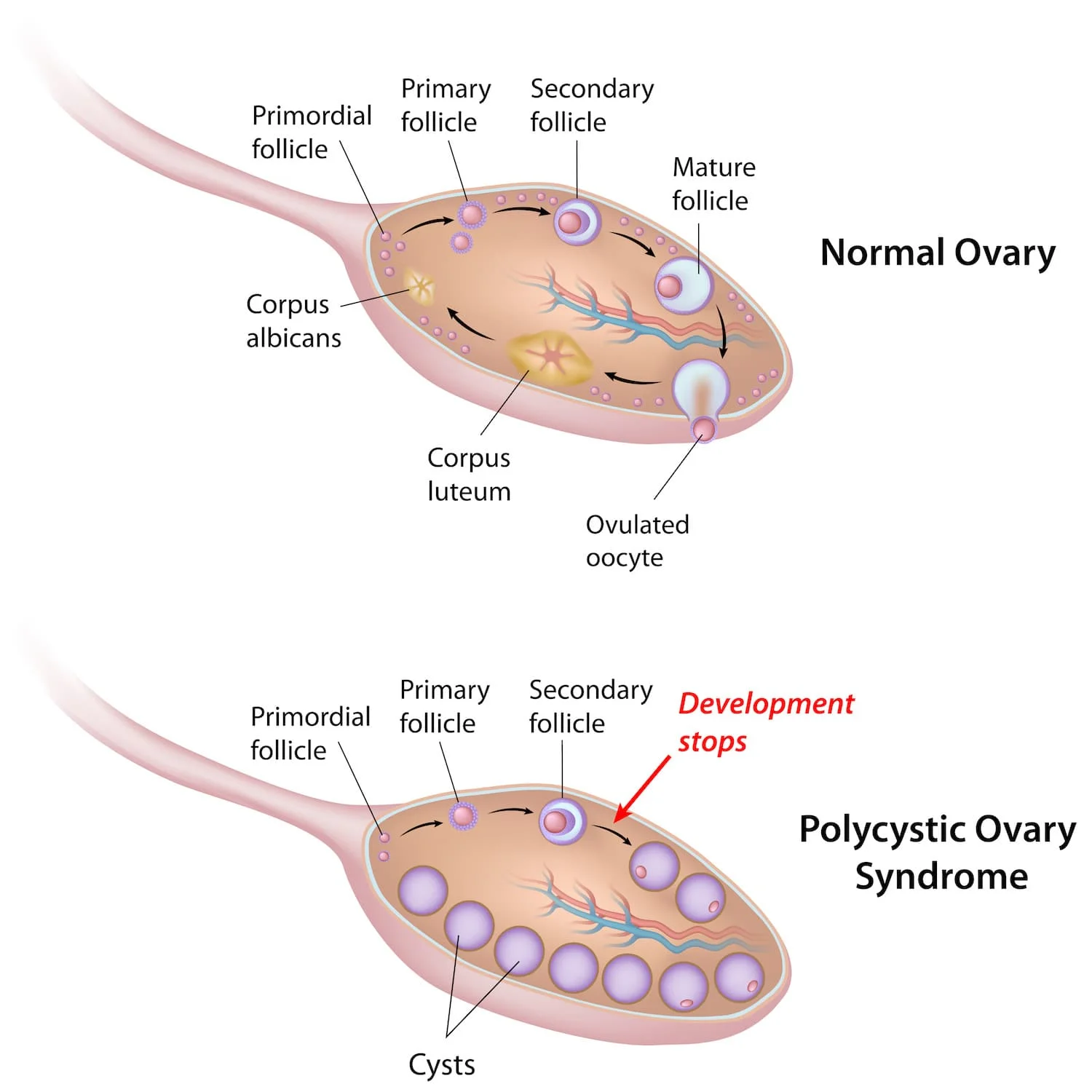 PCOS-min.jpeg
