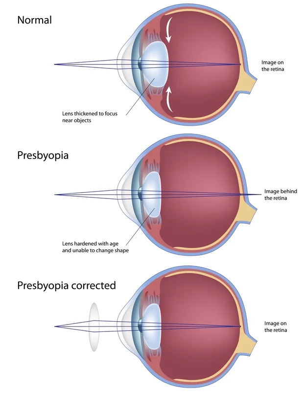 PRESBYOPIA (AGING EYES): Aging eyes, medically known as presbyopia, is a condition in which the lens of the eye gradually loses its flexibility, making it harder to focus clearly on close objects, such as printed words. Distance vision, on the other hand, is usually not affected. Unfortunately, presbyopia is an inevitable part of aging and cannot be prevented by diet, lifestyle, or visual habits. However, it is treatable with several types of corrective lenses, including progressives, bifocals and trifocals, single-vision reading glasses, multifocal contact lenses, and monovision therapy.