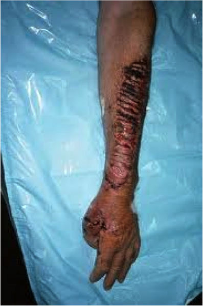 Chainsaw injuries 3.png