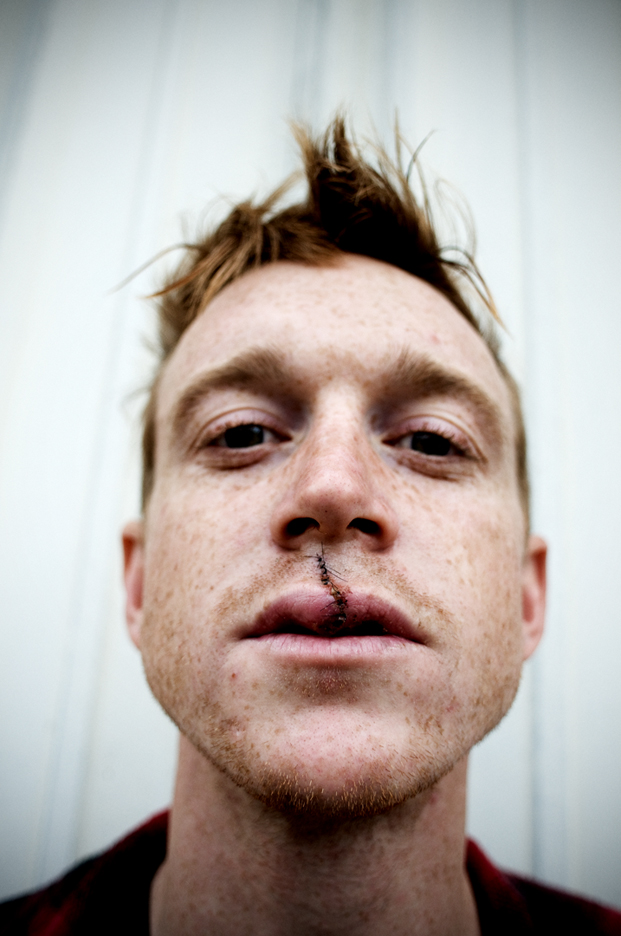 Brian_Heck_stitches_lip_DSC_5077_2.jpg