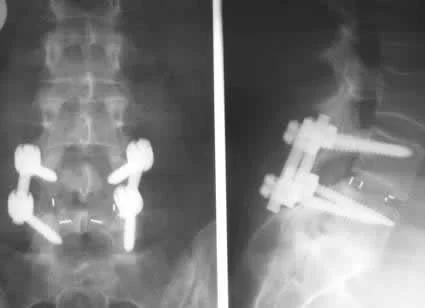 LumbarSpineFusion.jpg