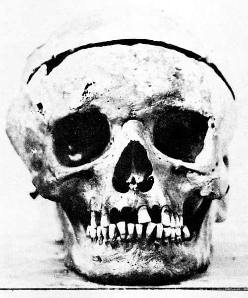 Beethoven's skull