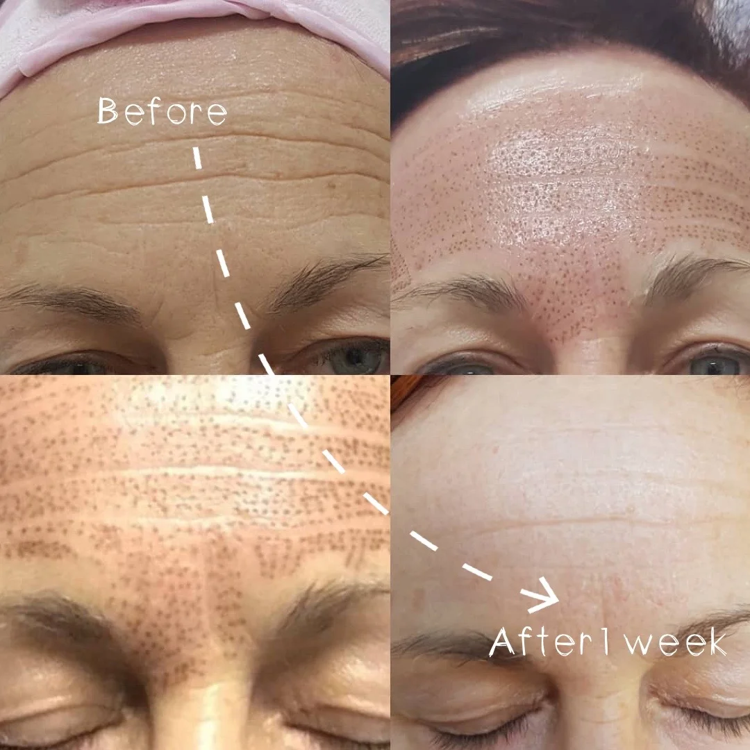 Plasma Fibroblast Forehead Treatment JUNE Promo $495