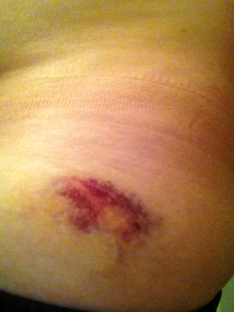  Bruised Hip 
