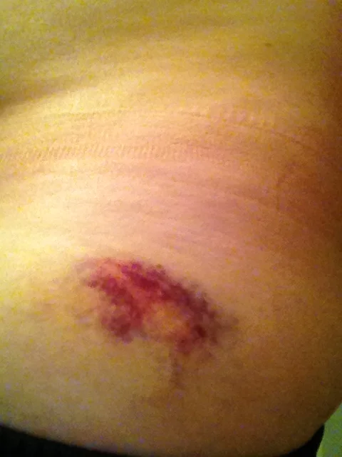  Bruised Hip 