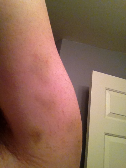  Bruise under arm. You can barely see it. 