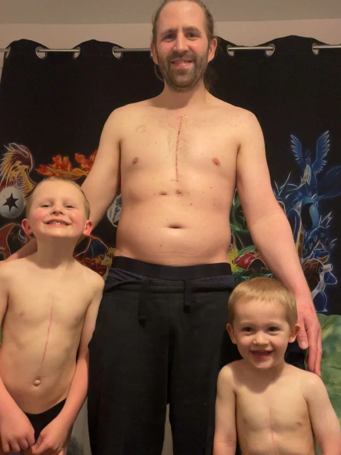Joshua and Lewie: &ldquo;I want a scratch like Daddy&rdquo; 🥰

I can&rsquo;t believe it&rsquo;s been a year today since my second surgery 😮
Since birth, I was diagnosed with a heart disease called Ebstein&rsquo;s anomaly. Thirty-eight years ago, op