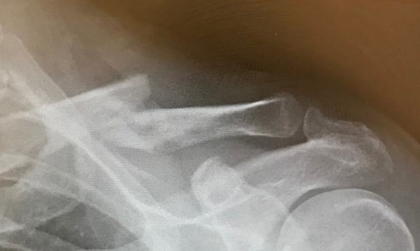 X Ray on the day of discharge from the Fracture Clinic.