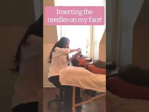 What can you expect in your Facial Rejuvenation Acupuncture