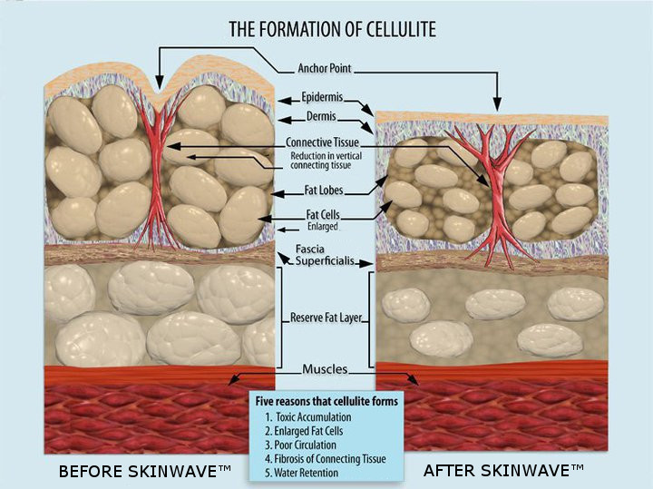 SkinWave is 100% natural and does not destroy any cells (it only shrinks them)! 