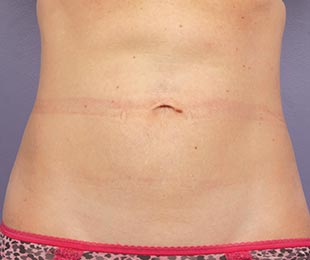 CoolSculpting after