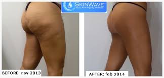 SkinWave patient before and after