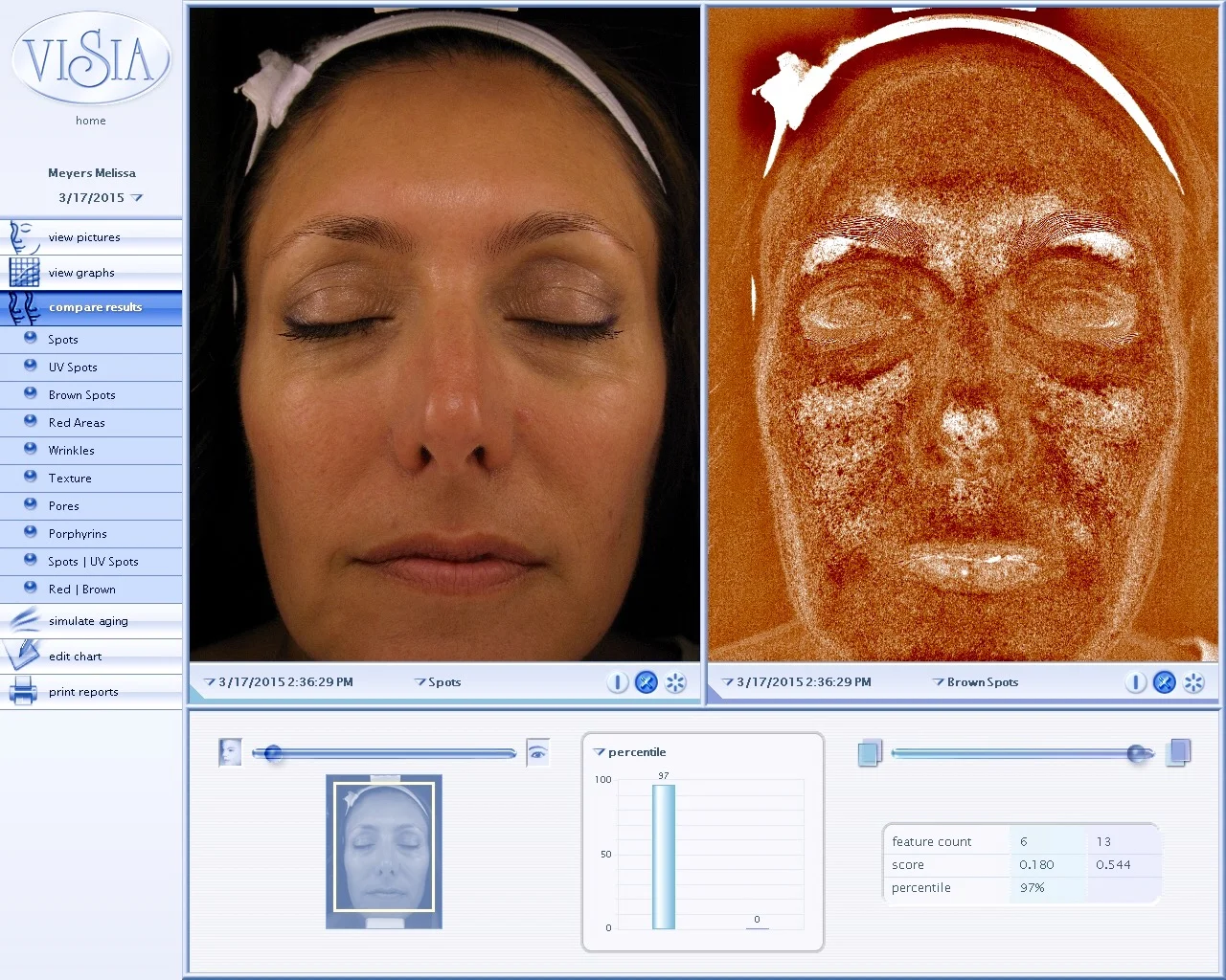 Visia Complexion skin analysis performed at the Koan Center show the improvement of your skin after treatments. 