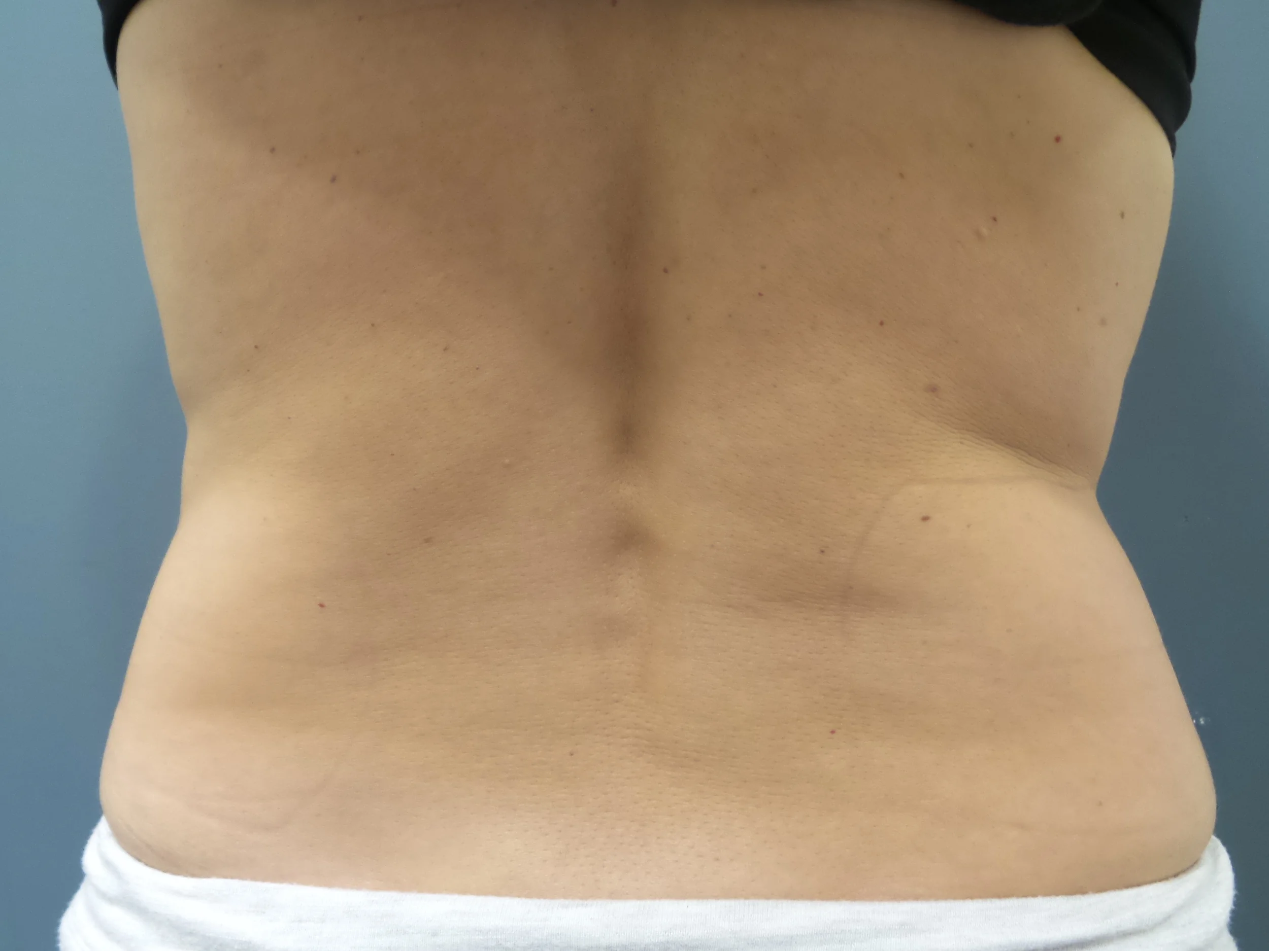 SculpSure before