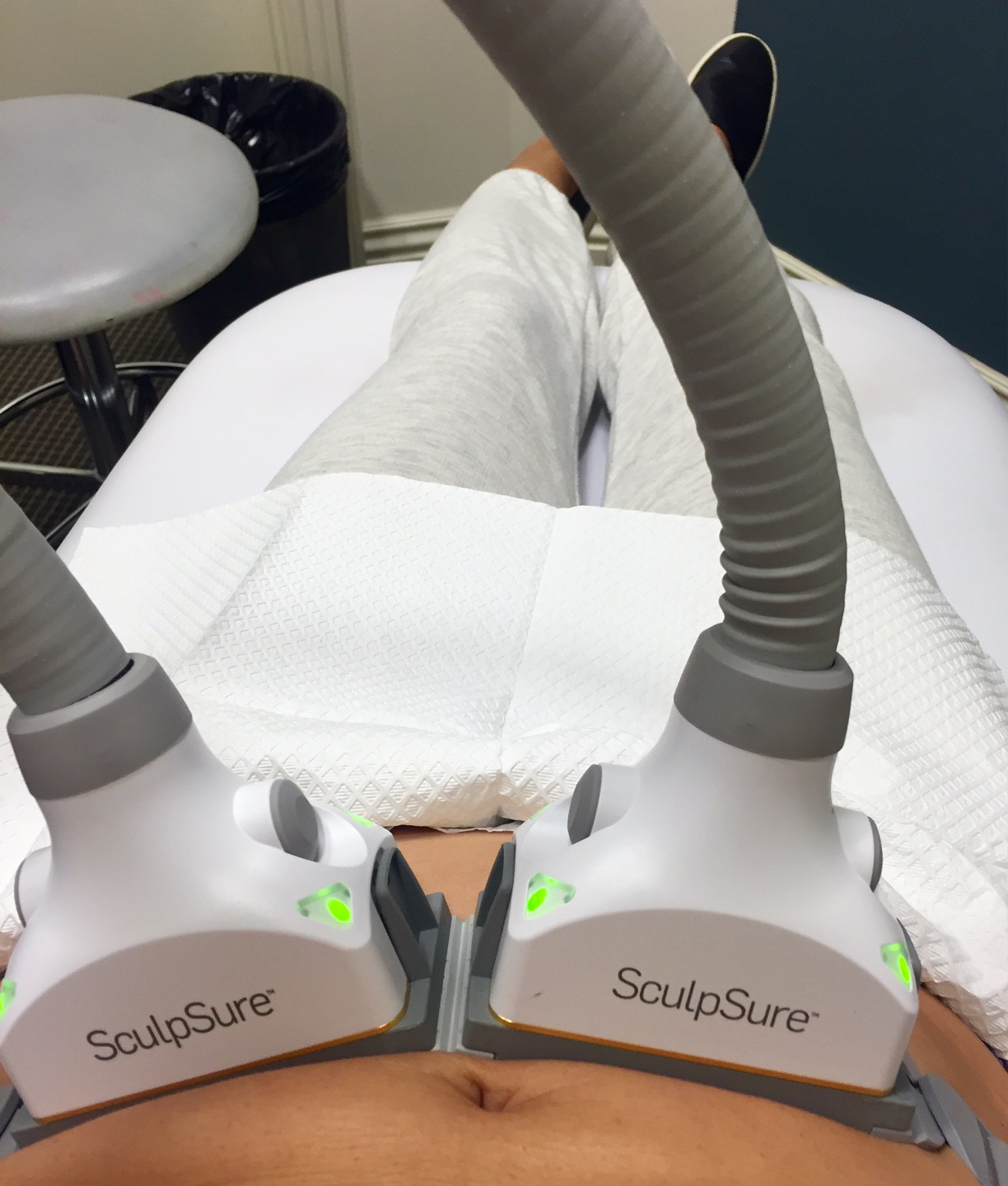 I also tried SculpSure and posted the results below from my flanks after one month. This was a painless treatment for me but I did feel a lot of heat during the procedure.