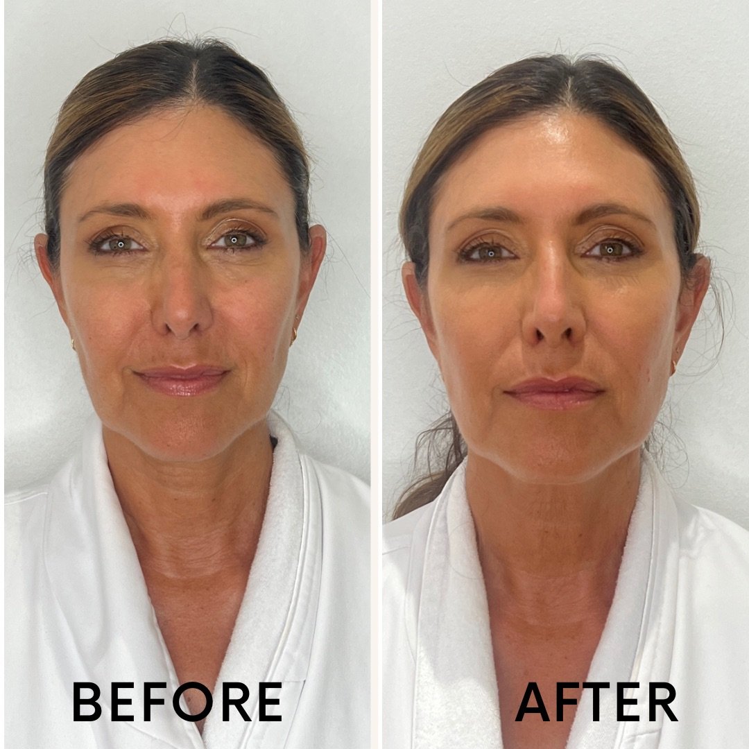 The Best Non-Invasive Treatment for Skin Tightening — The Glow